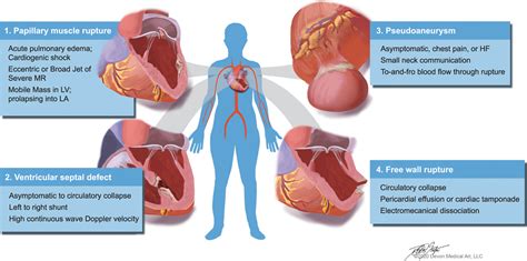 Left Ventricular Mass and the Risk of Sudden Cardiac .